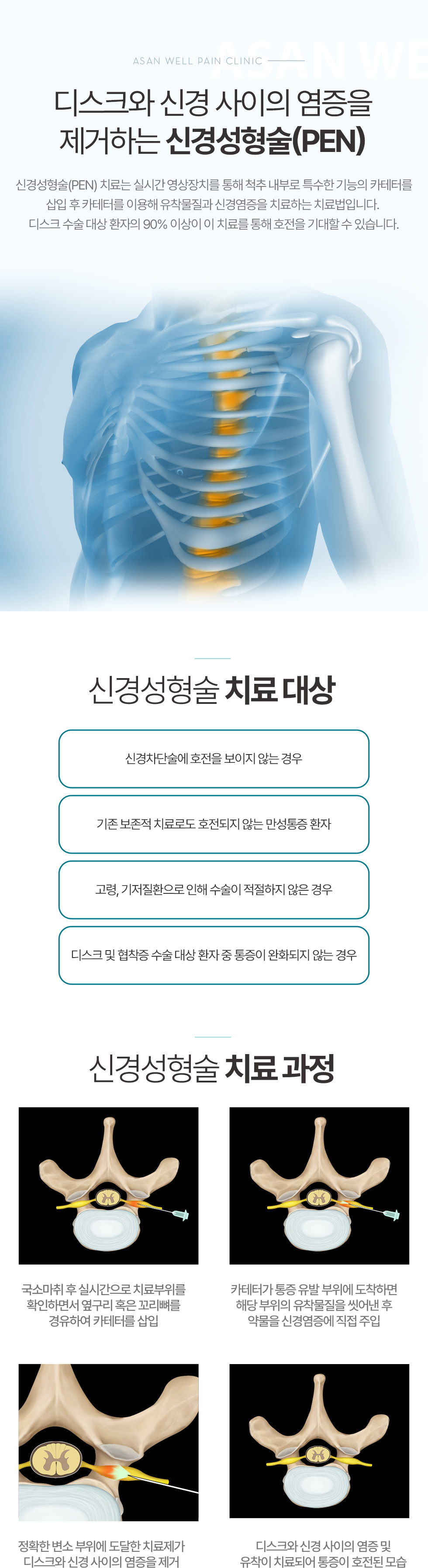 신경성형술(PEN)