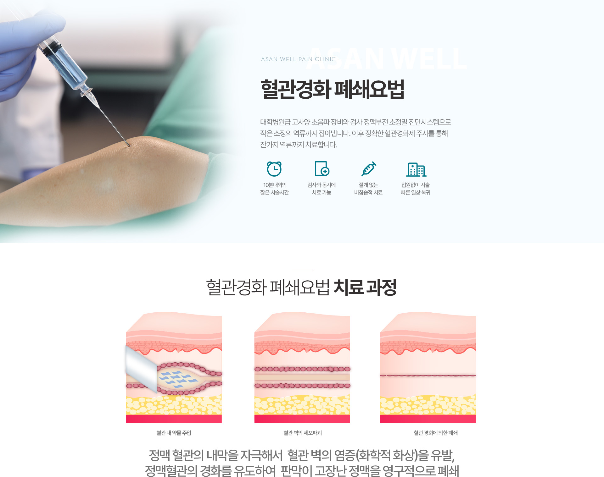베나실 시술